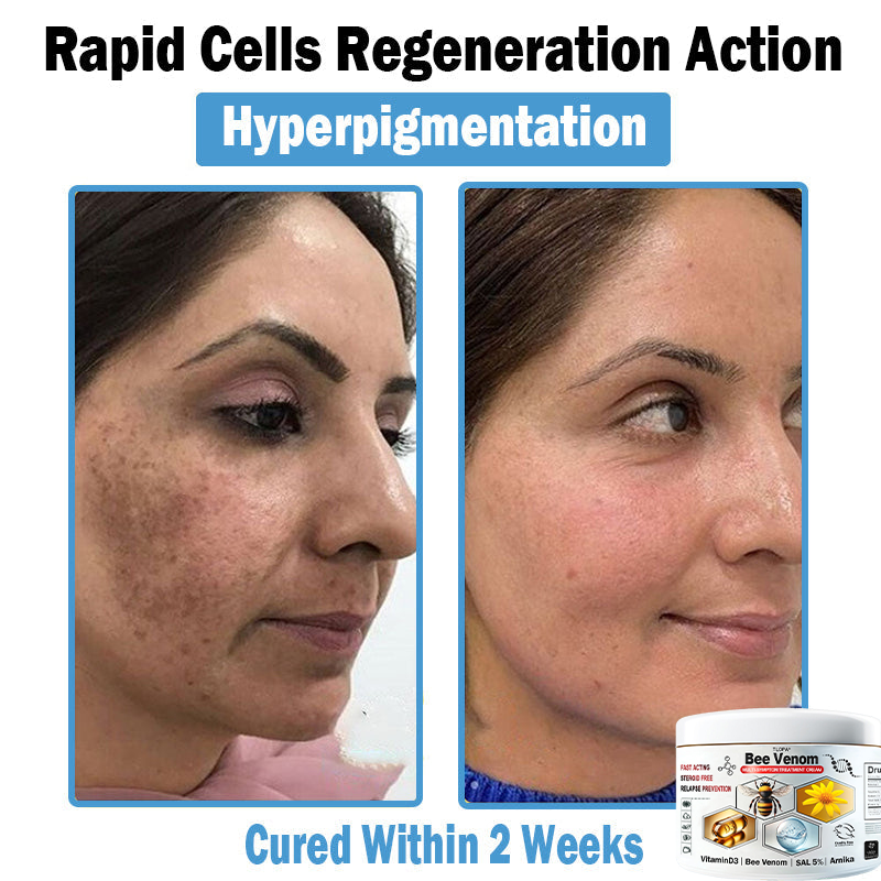 TLOPA® Bee Venom Multi-Symptom Skin Treatment Cream (👨‍⚕BAD RECOMMENDS)🌟Extra 30% off on sale items!